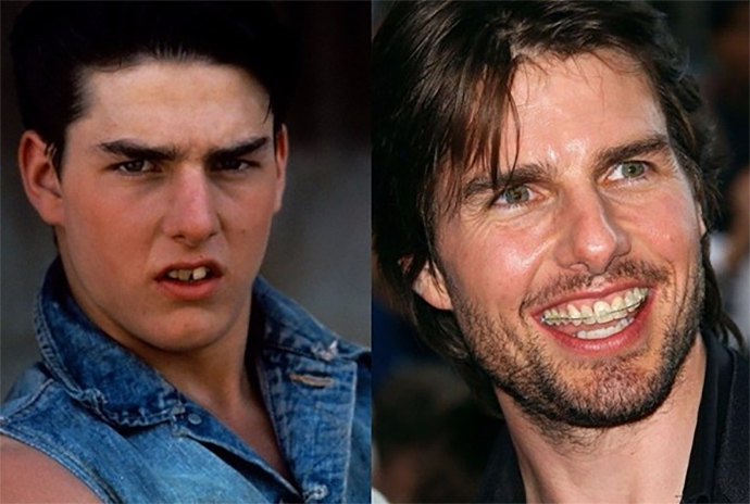 tom cruise first teeth